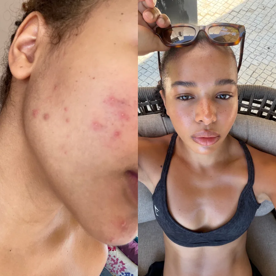 Before and after: skin clearing with Vanessa's approach